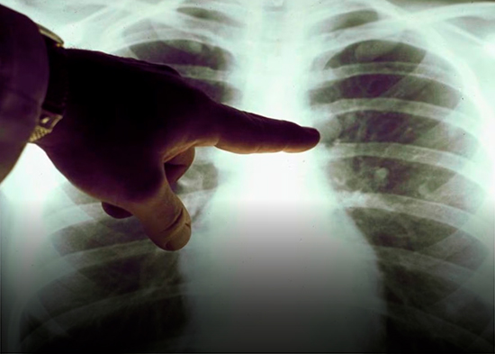 Estudio señala que la contaminación del aire promueve el cáncer de pulmón en no fumadores