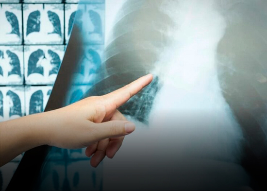 El cribado: la detección temprana para la cura del cáncer de pulmón