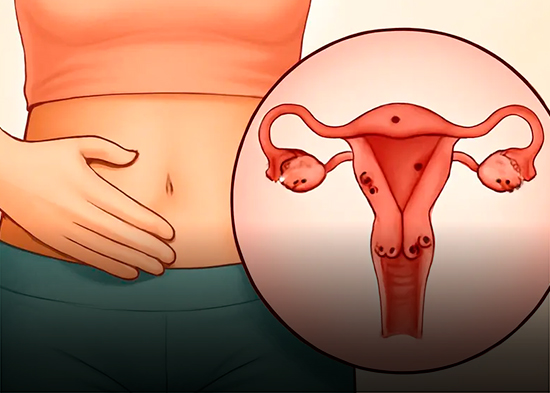 Endometriosis: Cuando el dolor menstrual no es normal