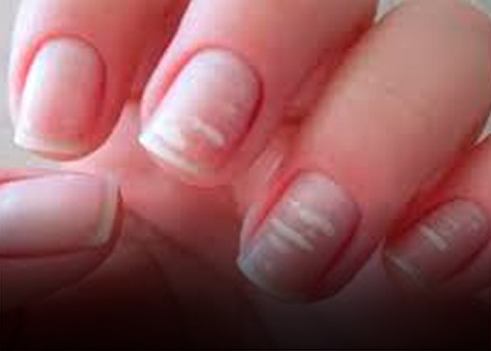 ¿Sabes por qué aparecen las manchas blancas en las uñas?